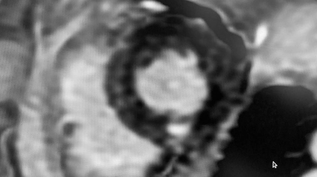 Cœur et COVID-19 : l’apport de l’IRM cardiaque